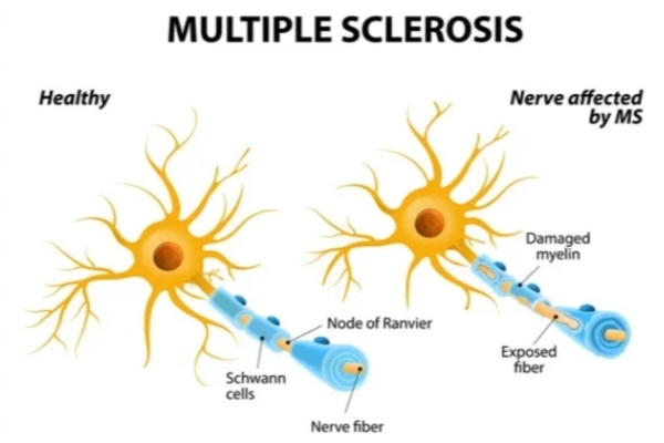  Multiple Sclerosis Treatment in Thane – Dr. Deepak Aiwale Best Multiple Sclerosis Specialist Near Me