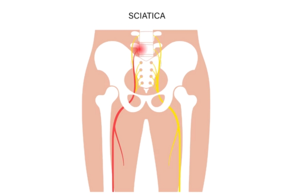  Best Sciatica Treatment in Thane – Relieve Radiating Pain Effectively