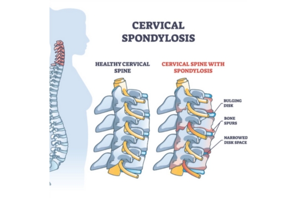  Cervical Spondylosis Treatment by Top Neurologist in Thane Dr. Deepak Aiwale: Your Cervical Spondylo