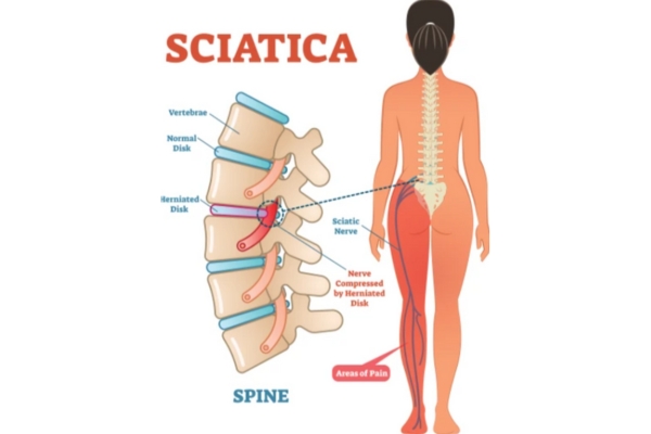  Sciatica Relief with Dr. Deepak Aiwale in Thane Dr. Deepak Aiwale: Sciatica Specialist in Thane