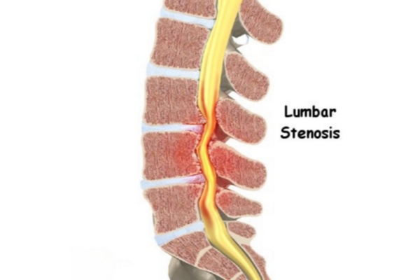 Comprehensive Care for Lumbar Canal Stenosis by Dr. Deepak Aiwale Dr. Deepak Aiwale: Expert in Lumbar Canal Stenosis