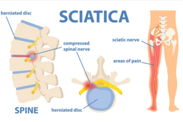  Sciatica Specialist in Thane – Dr. Deepak Aiwale Best Sciatica Specialist in Thane Get Effective Relief