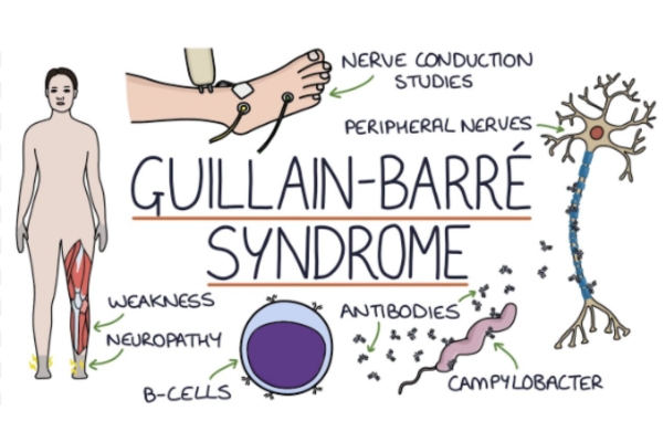  GBS (Guillain-Barré Syndrome) Specialist in Thane Expert GBS Treatment in Thane Comprehensive Care