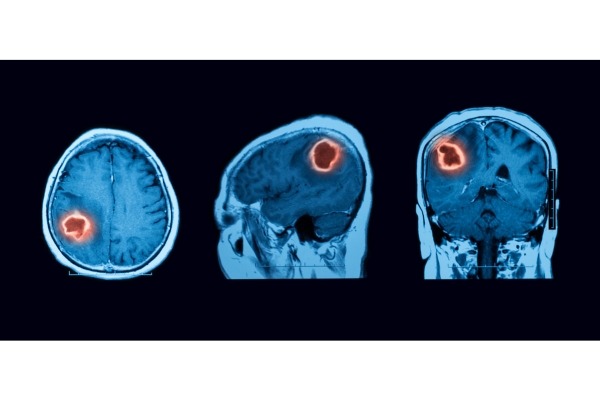  Brain Tumor Specialist in Thane Best Brain Tumor Specialist in Thane – Dr. Deepak Aiwale