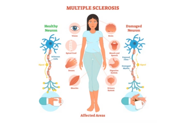  Dr. Deepak Aiwale Neurologist in Thane – Treating Multiple Sclerosis with Expertise Living with mult