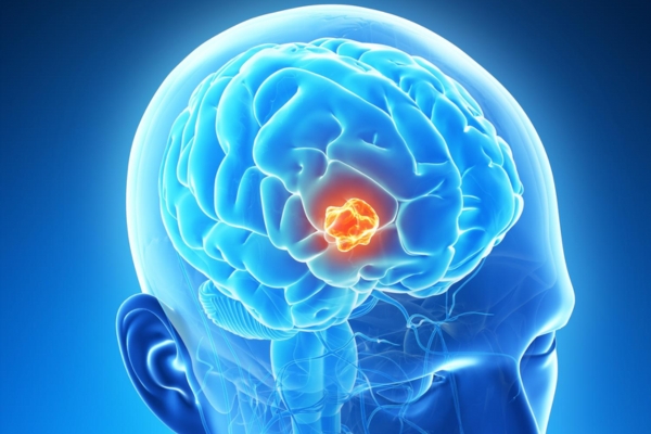  Best Brain Tumor Treatment in Thane with Expert Neurological Care