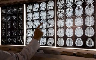 Best Neurologist in Thane
