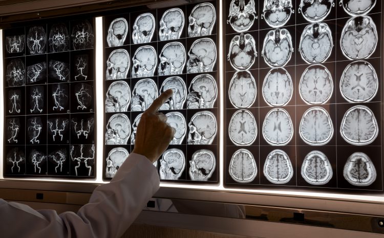  Early Signs of Memory Loss You Shouldn’t Ignore