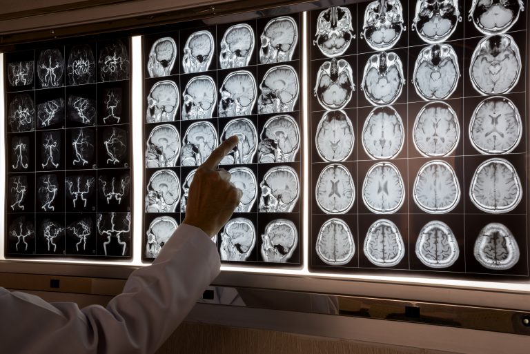 Best Neurologist in Thane